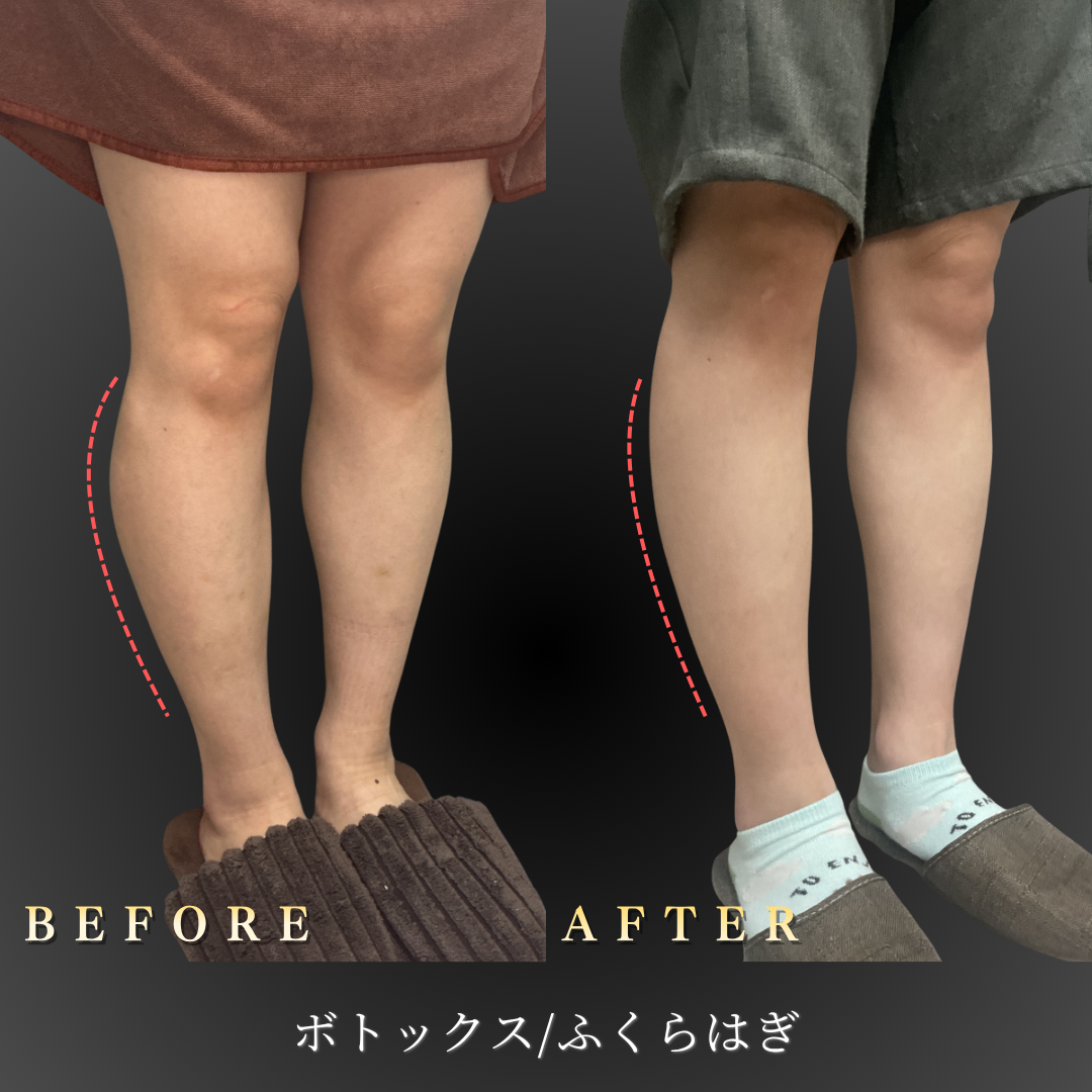 20代女性のふくらはぎボトックス症例写真（右45度ビフォーアフター）