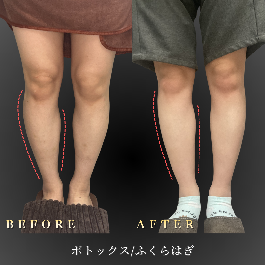 20代女性のふくらはぎボトックス症例写真（正面ビフォーアフター）