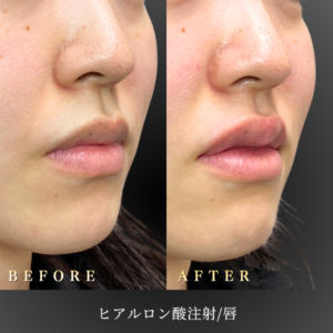 20代 唇ヒアルロン 症例写真〔右45度Before_After〕｜大阪 心斎橋BiBiクリニック