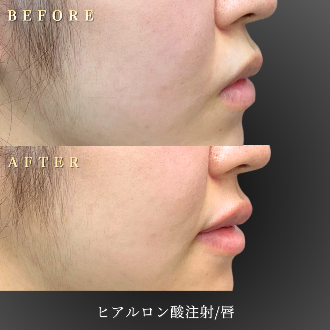 20代女性の唇ヒアルロン酸注入 右横アングルBefore/After｜大阪・心斎橋BiBiクリニック