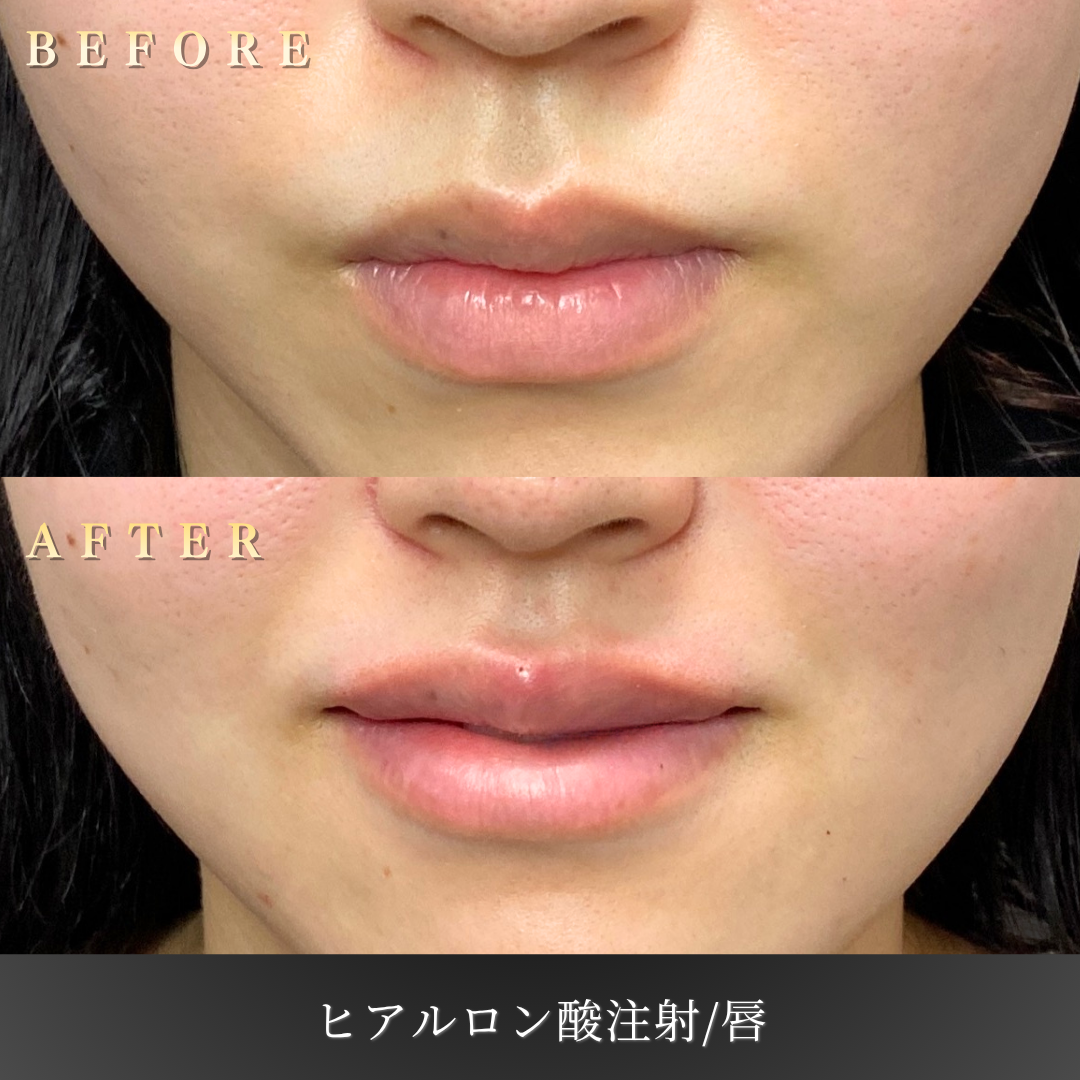 20代女性の唇ヒアルロン酸注入 正面Before/After｜大阪・心斎橋BiBiクリニック