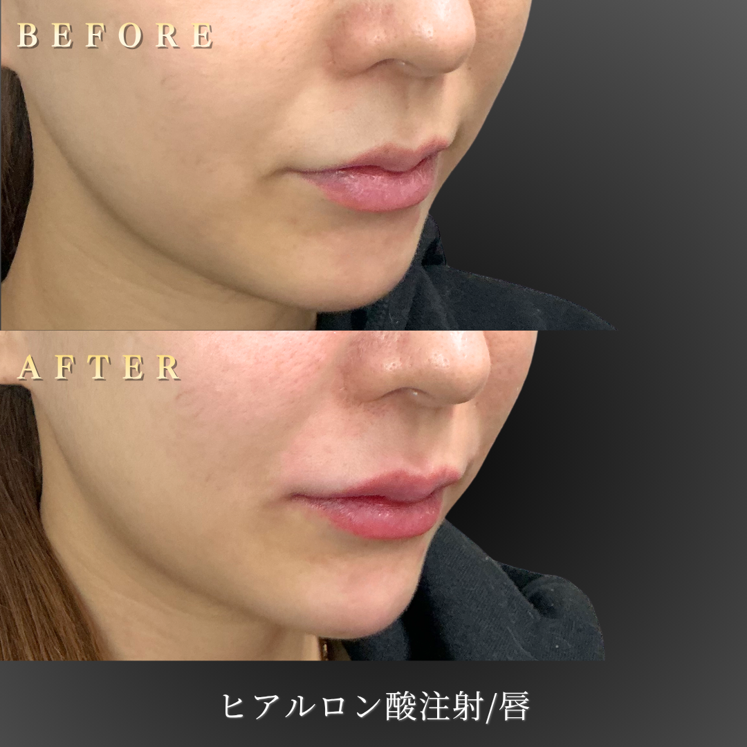 20代女性の唇ヒアルロン酸 右45度Before/After｜大阪・心斎橋BiBiクリニック