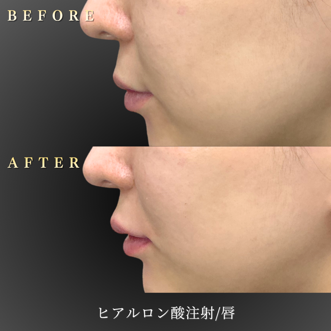 20代女性 唇ヒアルロン酸 左横Before/After｜大阪・心斎橋BiBiクリニック