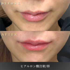 20代 唇ヒアルロン酸 症例写真〔正面Before_After〕｜大阪 心斎橋BiBiクリニック