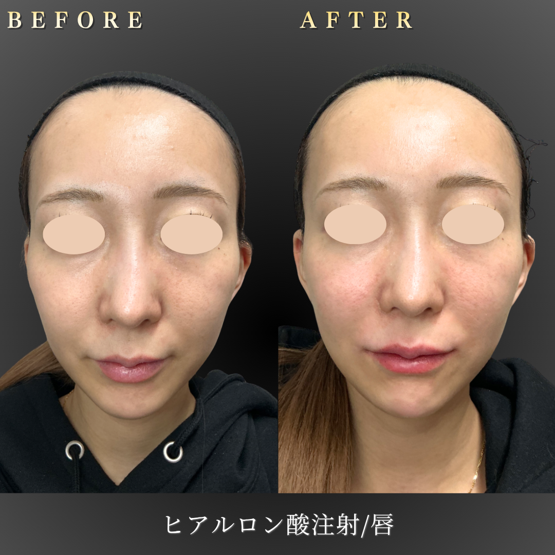 20代女性の唇ヒアルロン酸施術 正面アップBefore/After｜大阪・心斎橋BiBiクリニック