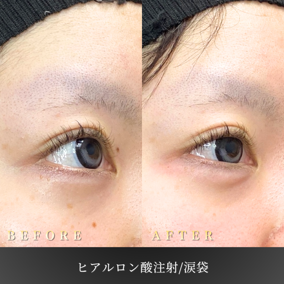 20代女性の涙袋ヒアルロン酸注入 右斜め45度ビフォーアフター｜大阪・心斎橋BiBiクリニック