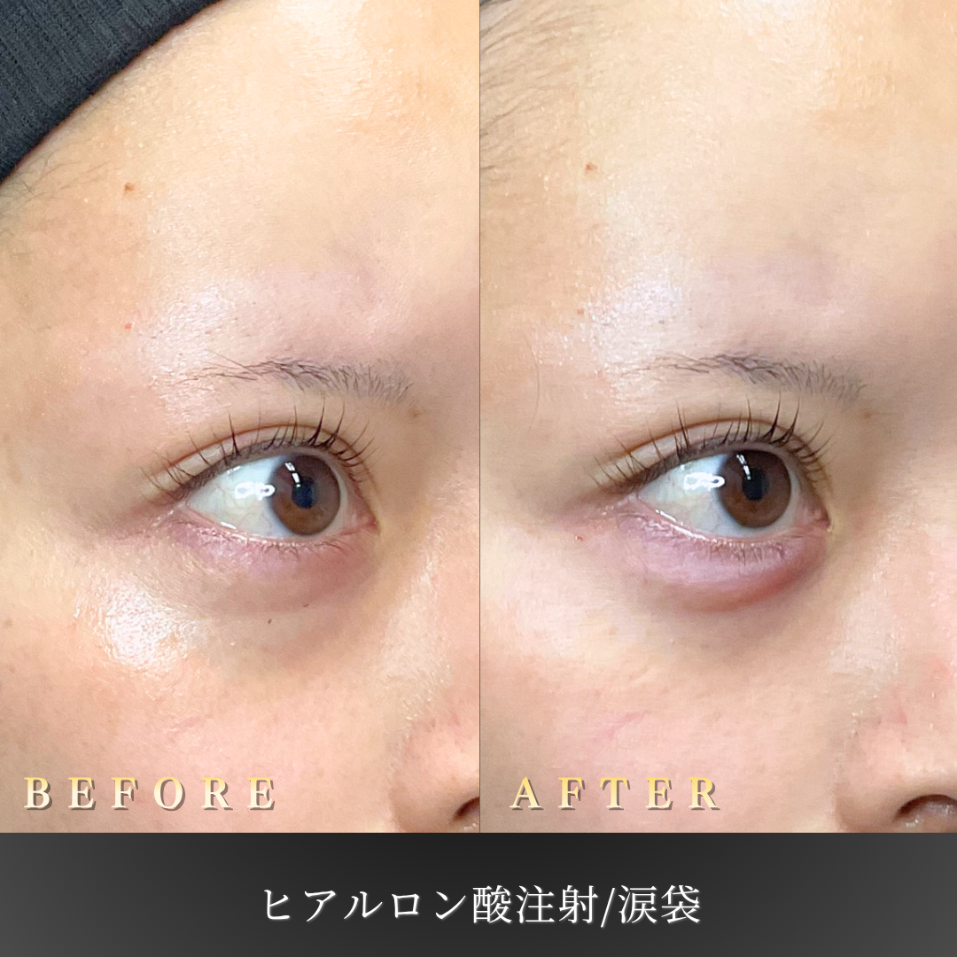 20代女性 涙袋ヒアルロン酸（ボリフト）右45度 Before/After｜大阪・心斎橋BiBiクリニック