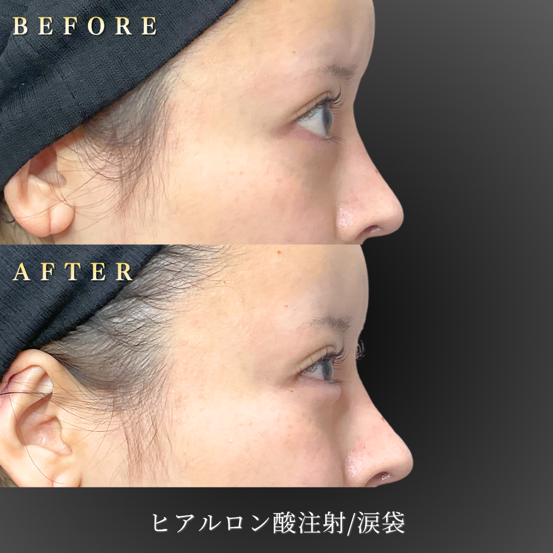 20代女性 涙袋ヒアルロン酸（ボリフト）右横 Before/After｜大阪・心斎橋BiBiクリニック