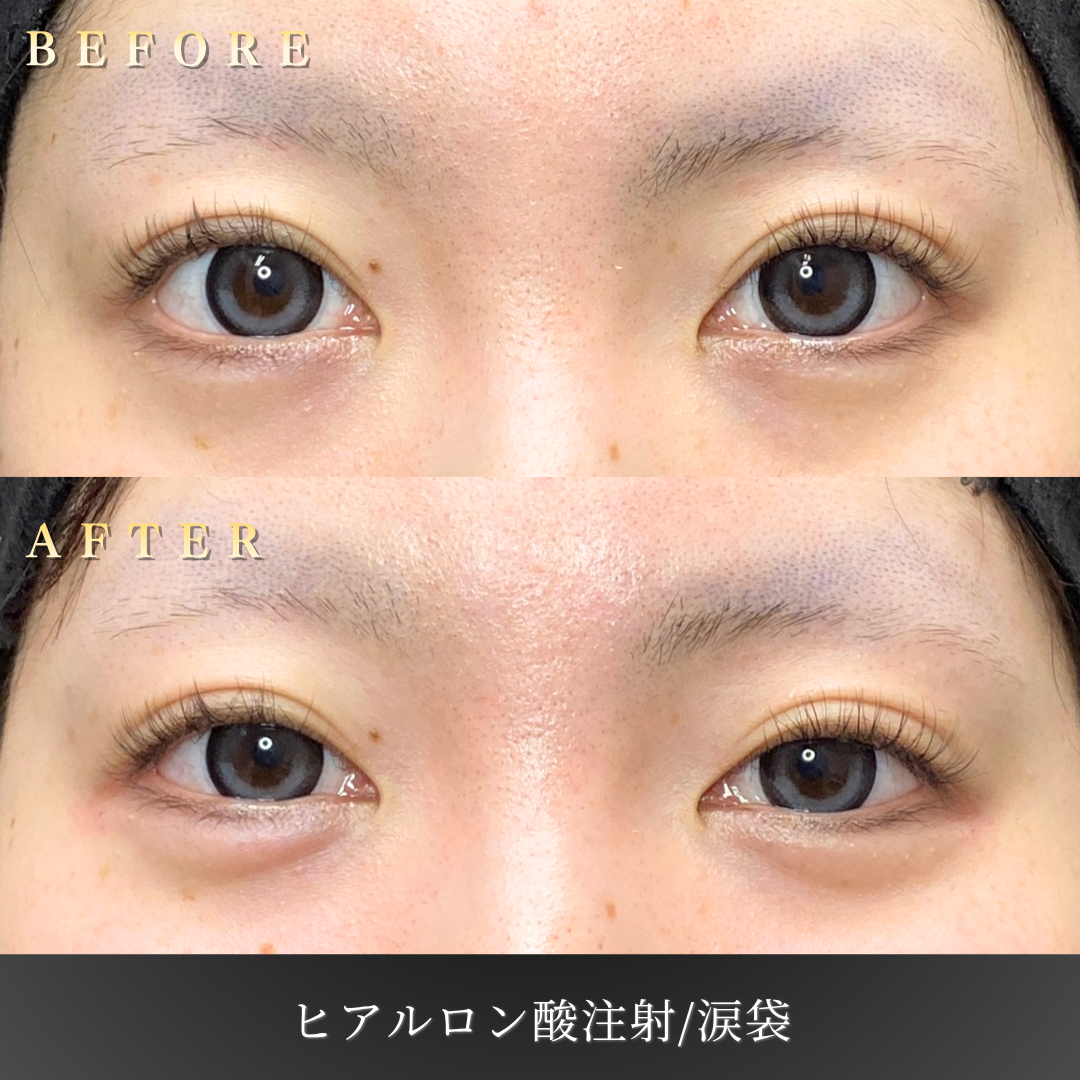 【20代女性】涙袋ヒアルロン酸で自然な目元の丸みを形成｜大阪・心斎橋BiBiクリニックの症例写真