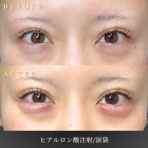 20代 涙袋ヒアルロン 症例写真〔正面Before_After〕｜大阪 心斎橋BiBiクリニック
