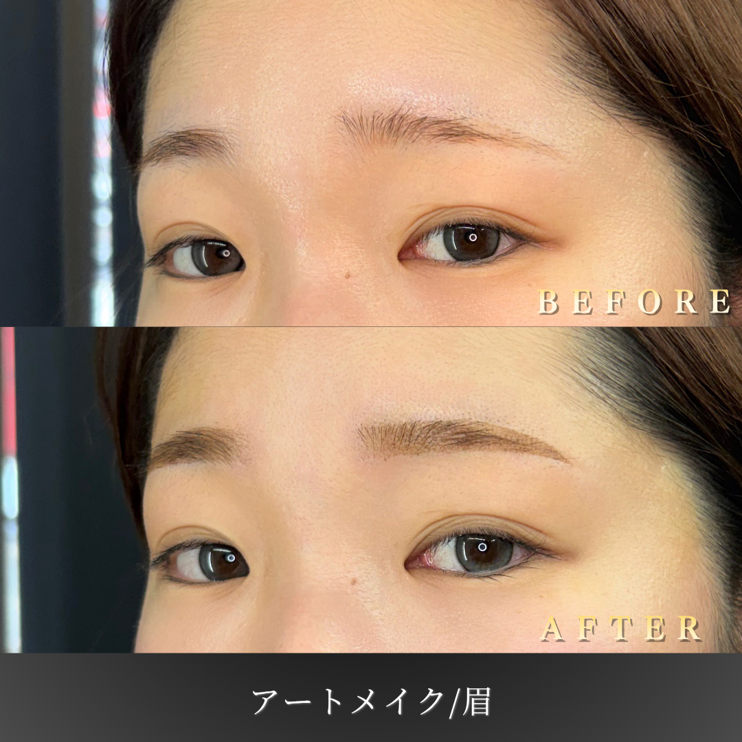 20代女性の眉アートメイク 左45度ビフォーアフター写真｜大阪・心斎橋BiBiクリニック