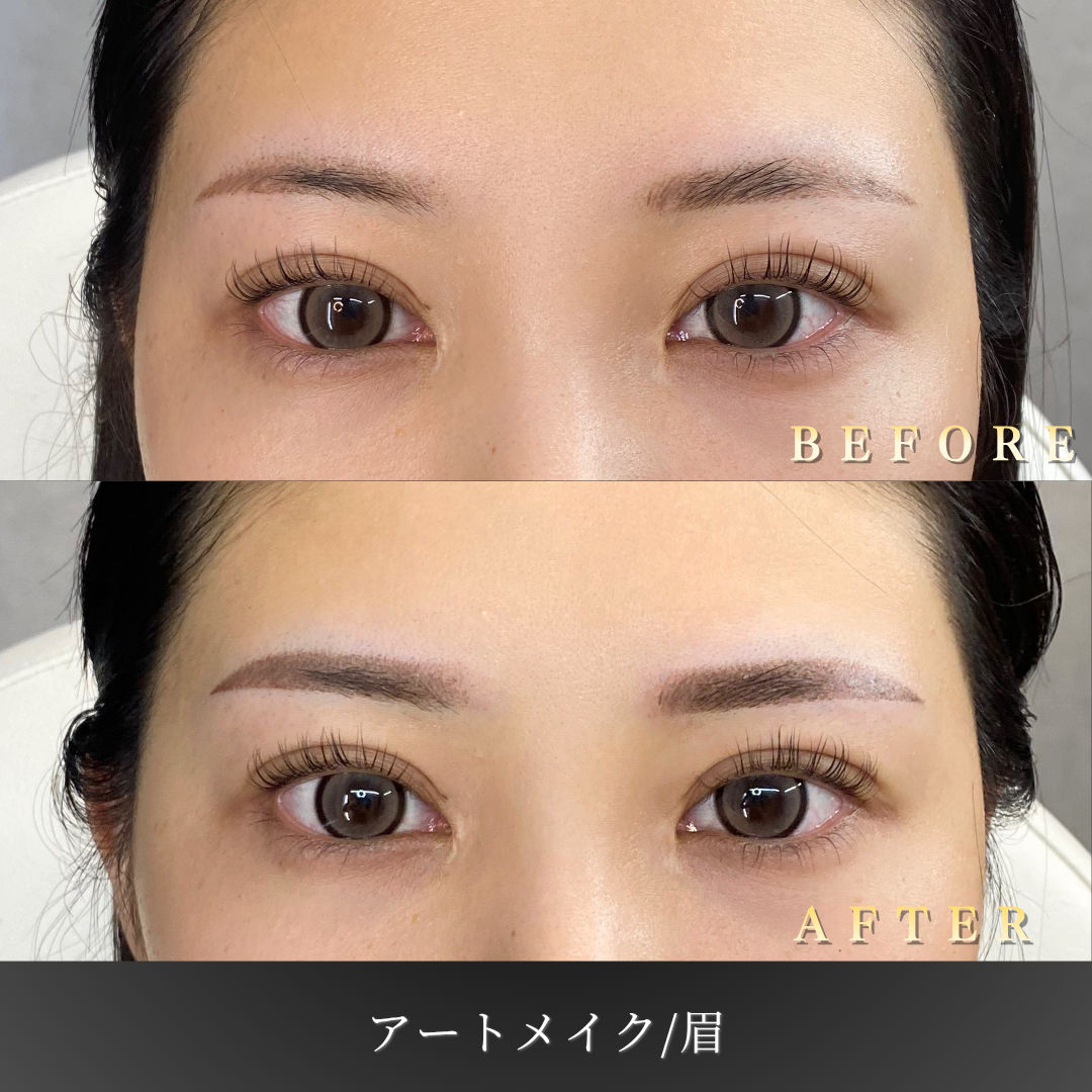 【20代女性】眉アートメイク（2D）左右差補正・平行アーチ｜大阪・心斎橋BiBiクリニックの症例写真