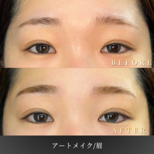 20代 眉アートメイク 症例写真〔正面Before_After〕｜大阪 心斎橋BiBiクリニック