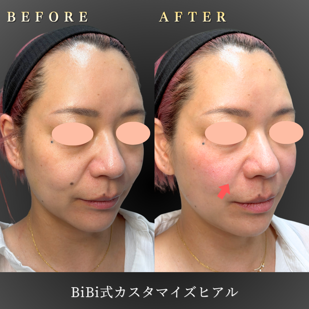 30代女性 BiBi式カスタマイズヒアルロン酸 右45度ビフォーアフター｜大阪・心斎橋BiBiクリニック