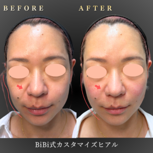 30代-カスタマイズヒアル-症例写真〔正面Before_After〕｜大阪-心斎橋BiBiクリニック2