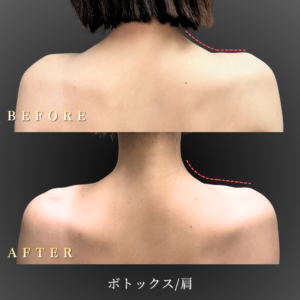 30代-肩ボトックス-症例写真〔背面Before_After〕｜大阪-心斎橋BiBiクリニック