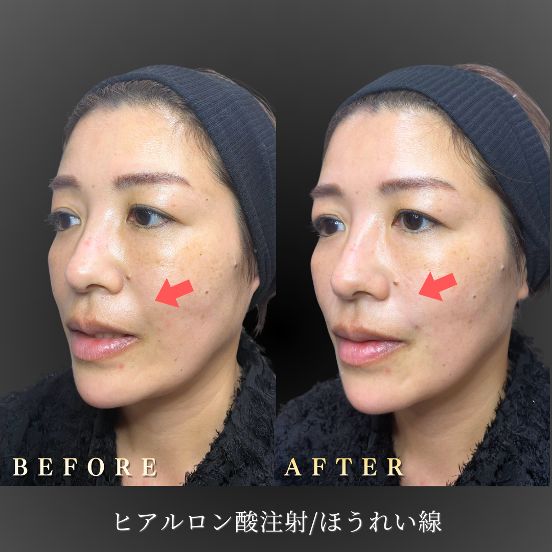 【40代女性】ほうれい線ヒアルロン酸注入で自然な若返り｜大阪・心斎橋BiBiクリニックの症例写真