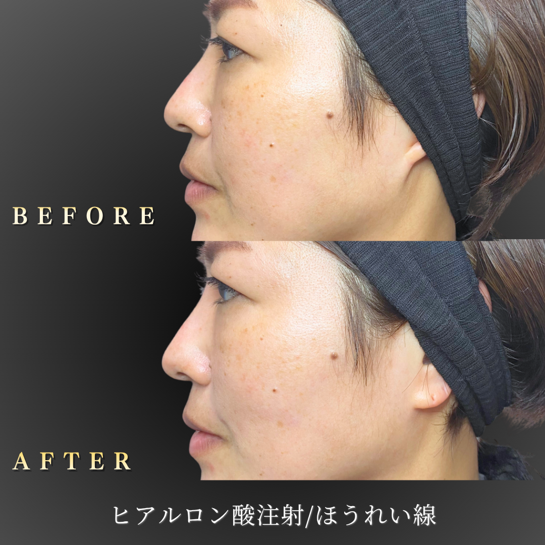 40代女性のほうれい線ヒアルロン酸症例写真・左横のBefore/After｜大阪・心斎橋BiBiクリニック