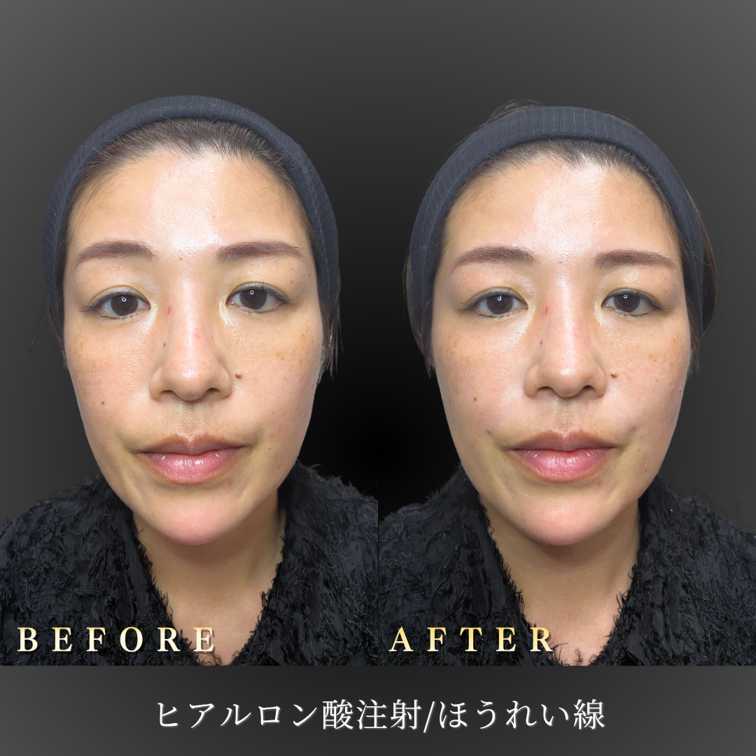 40代女性のほうれい線ヒアルロン酸症例写真・正面のBefore/After｜大阪・心斎橋BiBiクリニック
