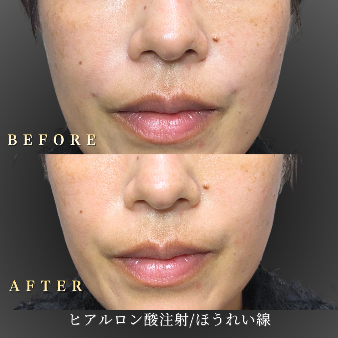 40代女性のほうれい線ヒアルロン酸症例写真・正面のBefore/After｜大阪・心斎橋BiBiクリニック