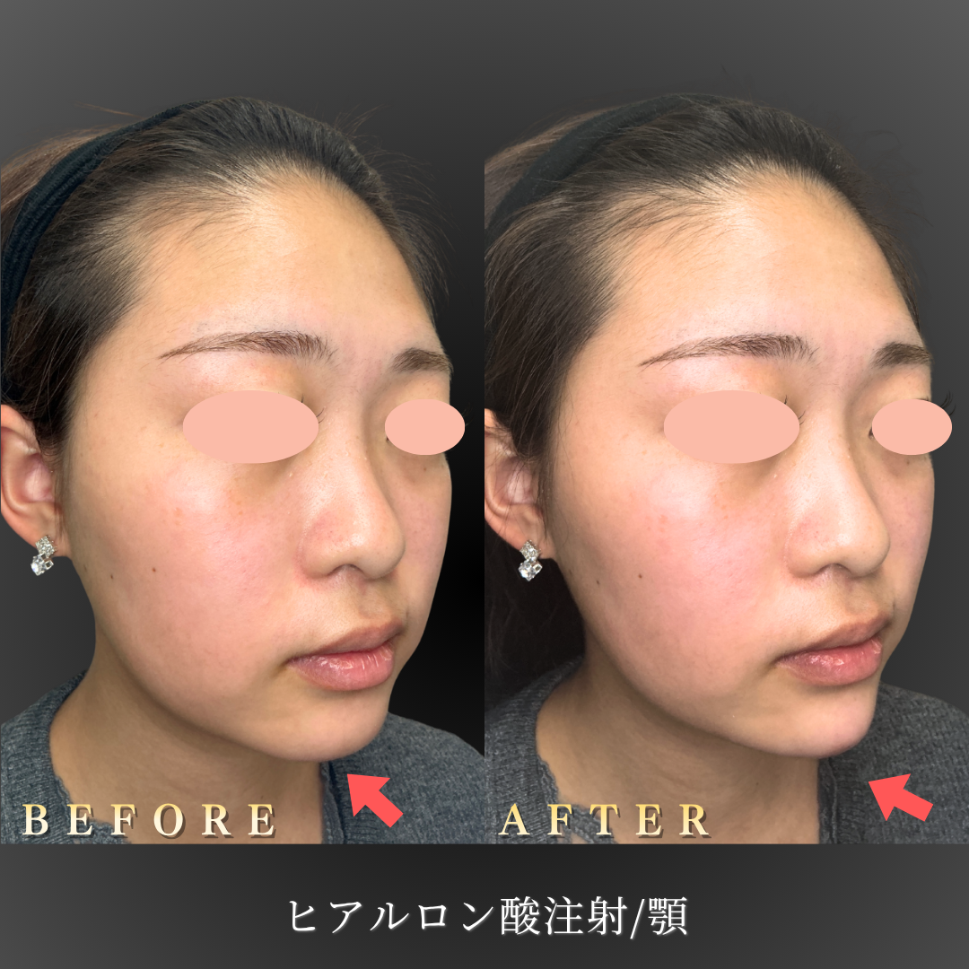 【10代女性】顎のヒアルロン酸注入症例｜大阪・心斎橋BiBiクリニックの症例写真