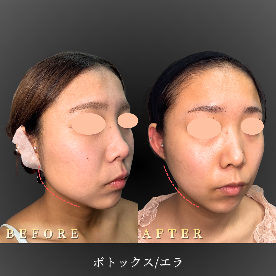 10代女性のエラボトックス症例写真（右斜め45度Before/After）｜大阪・心斎橋BiBiクリニック