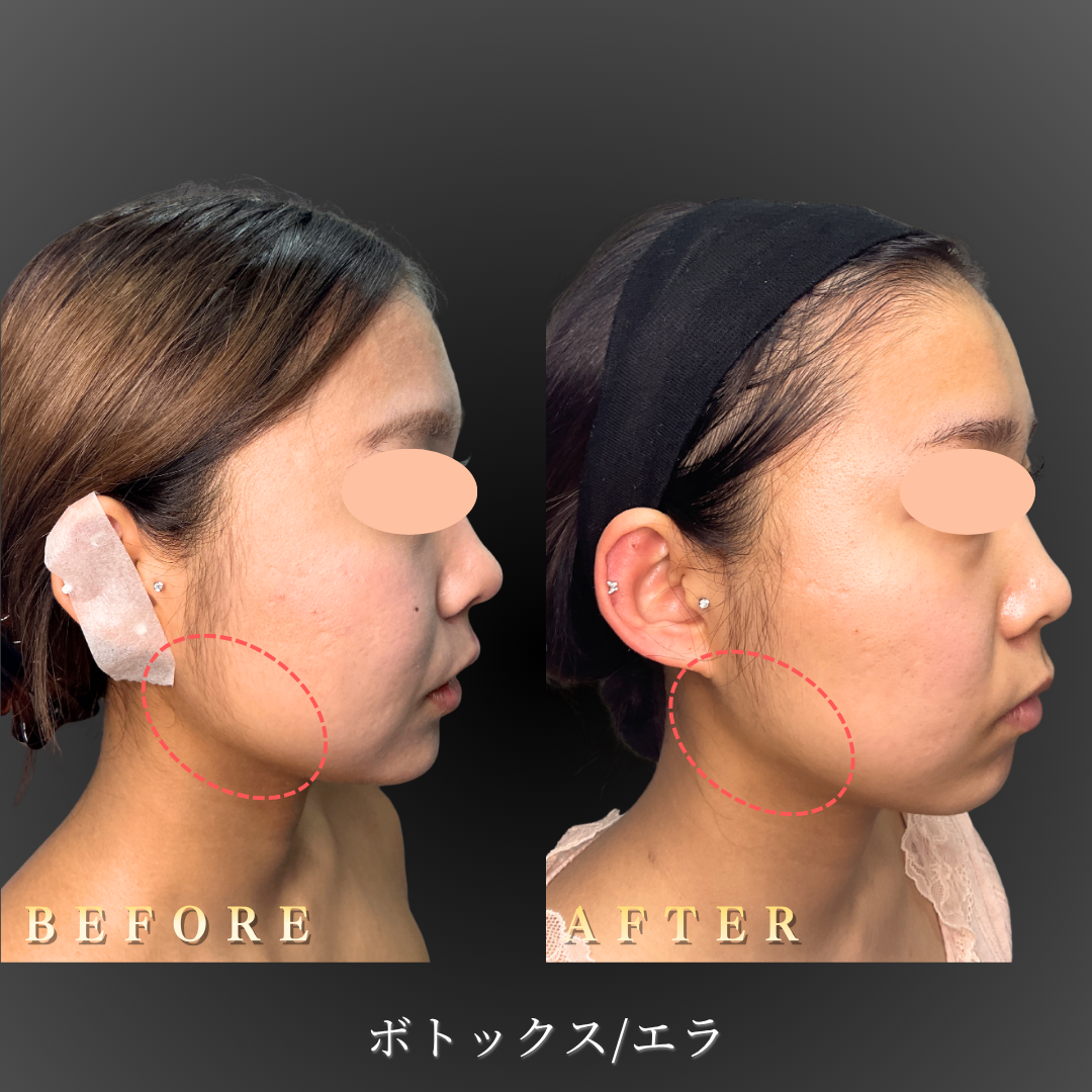 10代女性のエラボトックス症例写真（右横Before/After）｜大阪・心斎橋BiBiクリニック
