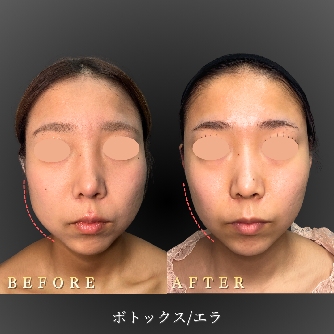 【10代女性】エラボトックスで輪郭すっきり小顔へ｜大阪・心斎橋BiBiクリニックの症例写真
