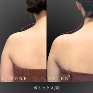20代-肩ボトックス-症例写真〔正面Before_After〕｜大阪-心斎橋BiBiクリニック