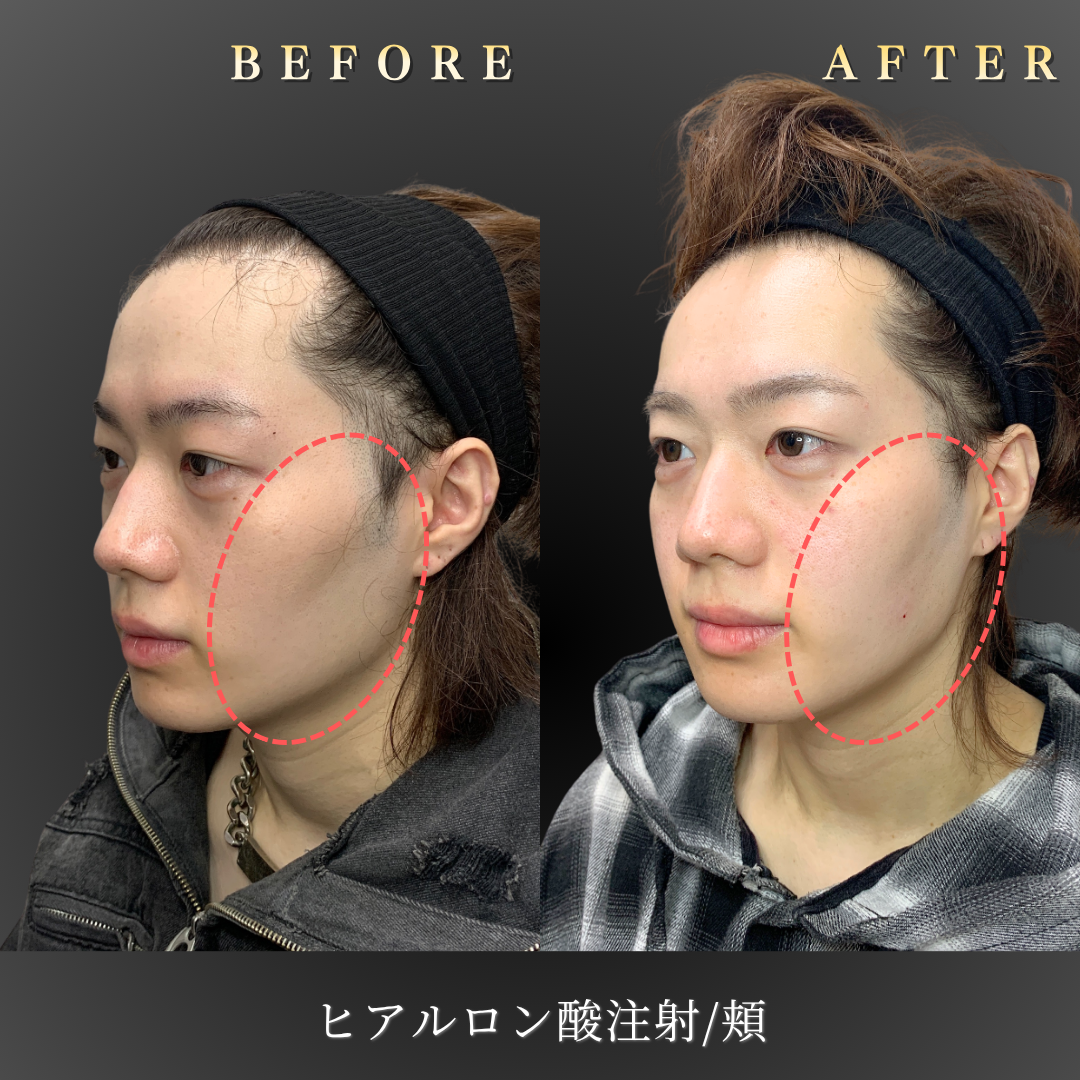 20代男性の頬ヒアルロン酸施術 右45度Before/After｜大阪・心斎橋BiBiクリニック