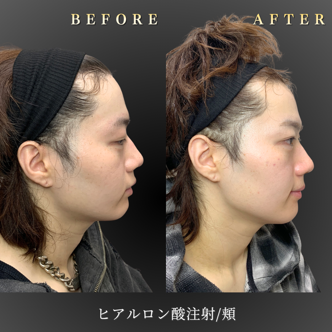 20代男性の頬ヒアルロン酸施術 右横Before/After｜大阪・心斎橋BiBiクリニック