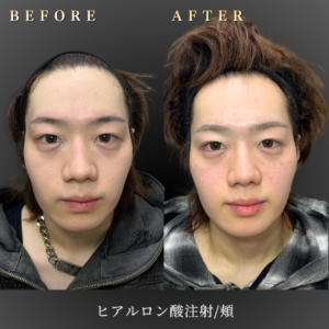20代 頬ヒアルロン酸 症例写真〔正面Before_After〕｜大阪 心斎橋BiBiクリニック
