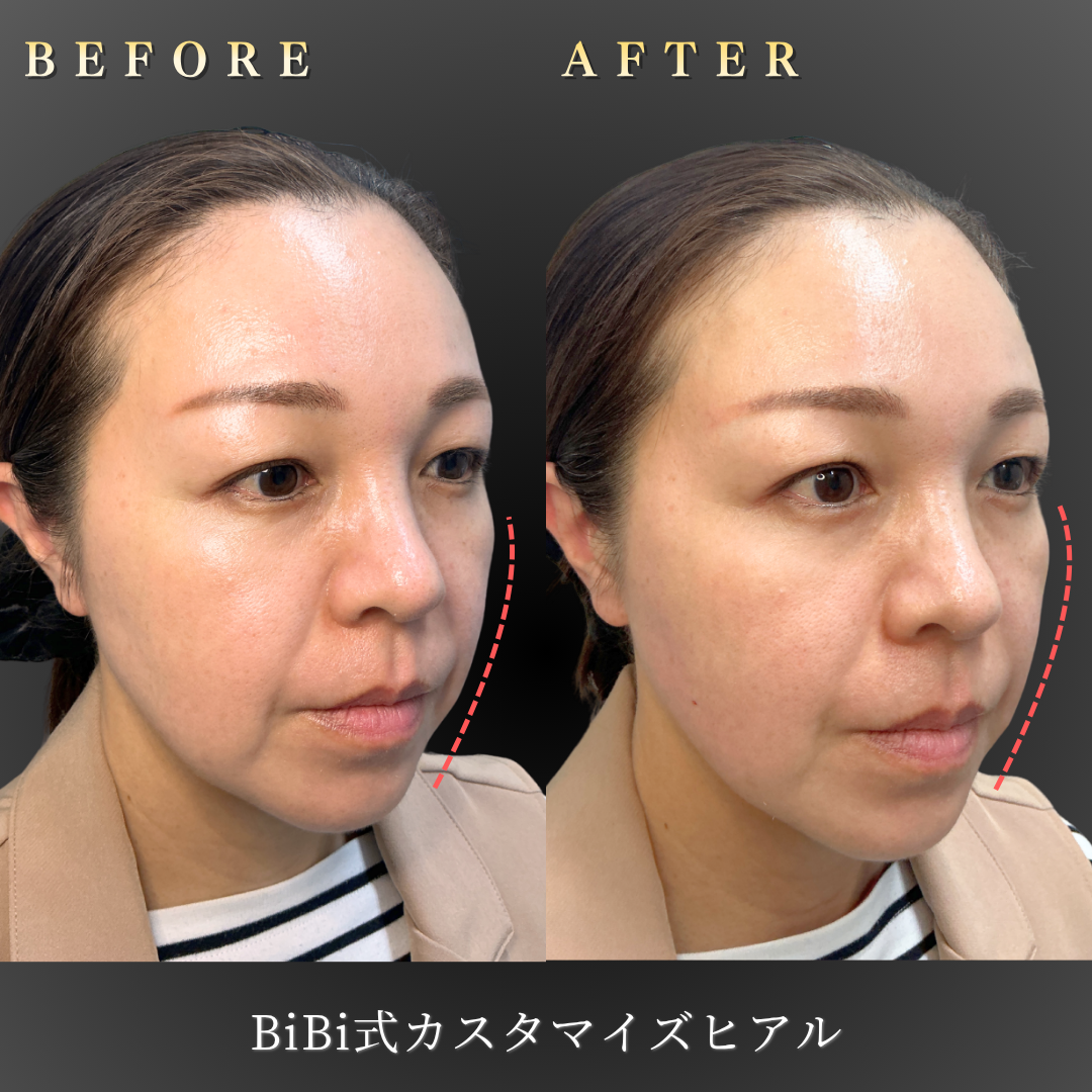 40代女性のBiBi式カスタマイズヒアル（こめかみ・頬）施術前後の右45度Before/After写真｜大阪・心斎橋BiBiクリニック