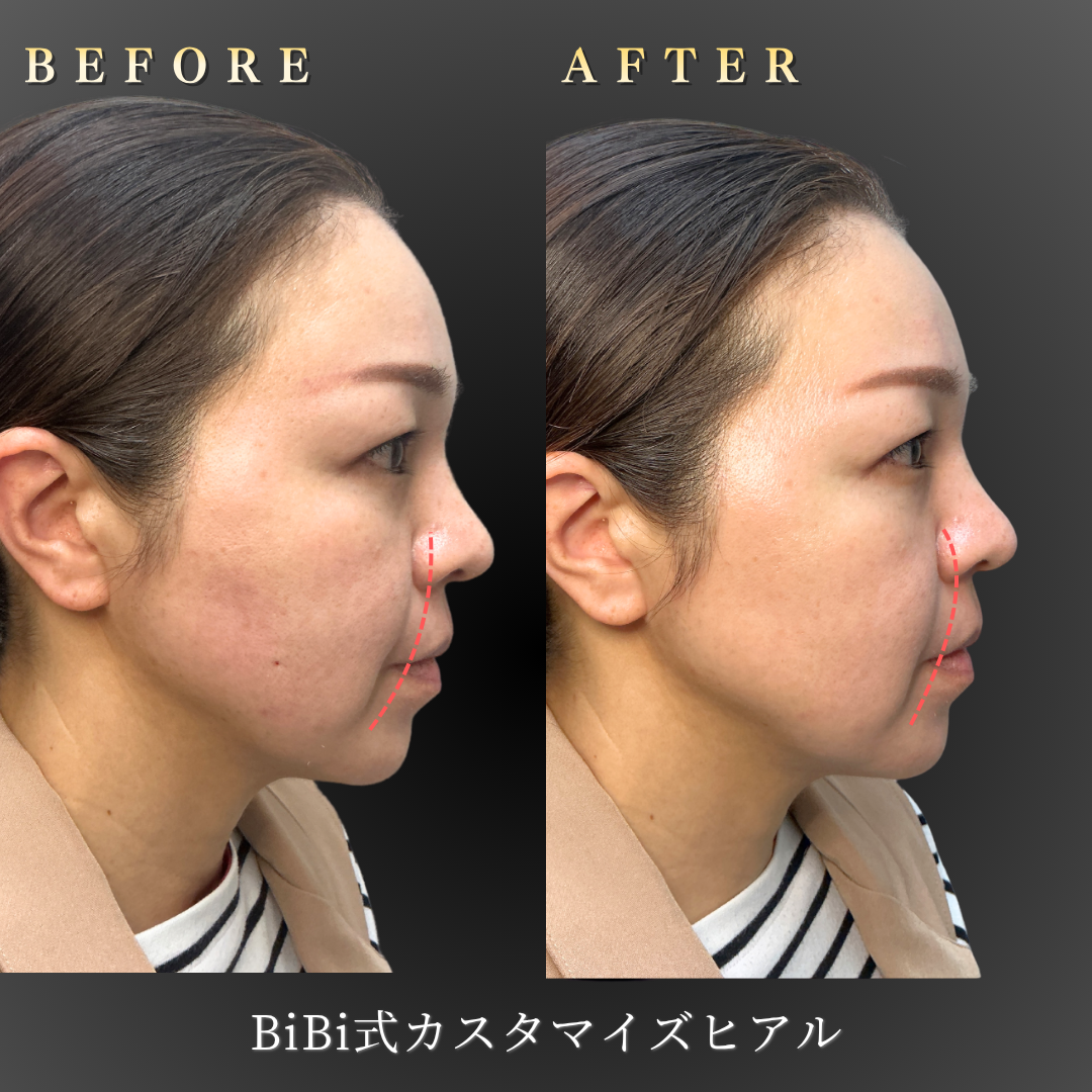 40代女性のBiBi式カスタマイズヒアル（こめかみ・頬）右横Before/After｜大阪・心斎橋BiBiクリニック