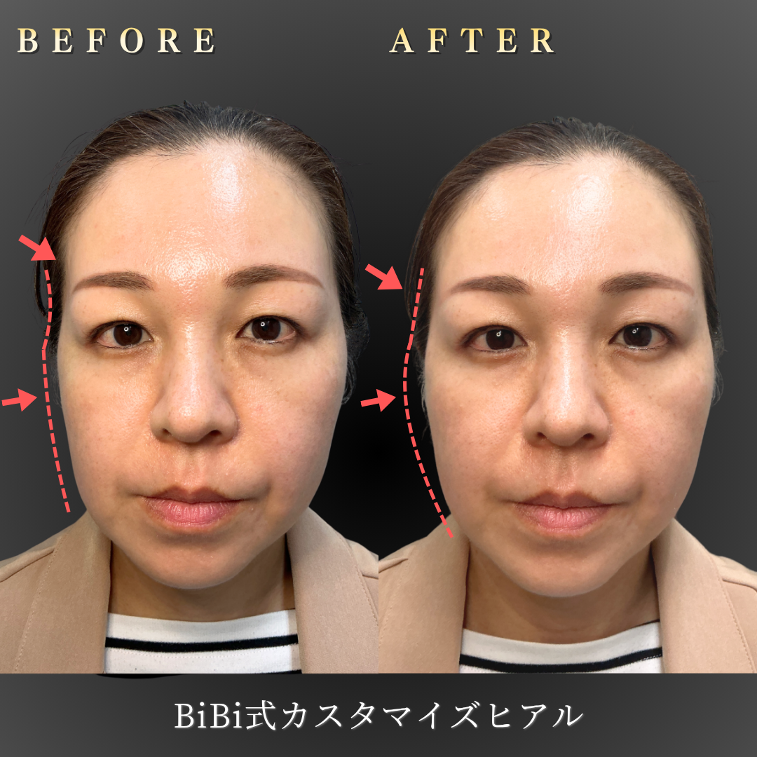 40代女性のBiBi式カスタマイズヒアル（こめかみ・頬）施術前後の正面アップBefore/After写真｜大阪・心斎橋BiBiクリニック