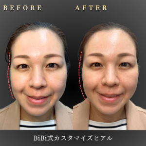 30代-カスタマイズヒアル-症例写真〔正面Before_After〕｜大阪-心斎橋BiBiクリニック