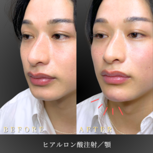 20代-アゴヒアルロン酸-症例写真〔左45度Before_After〕｜大阪-心斎橋BiBiクリニック