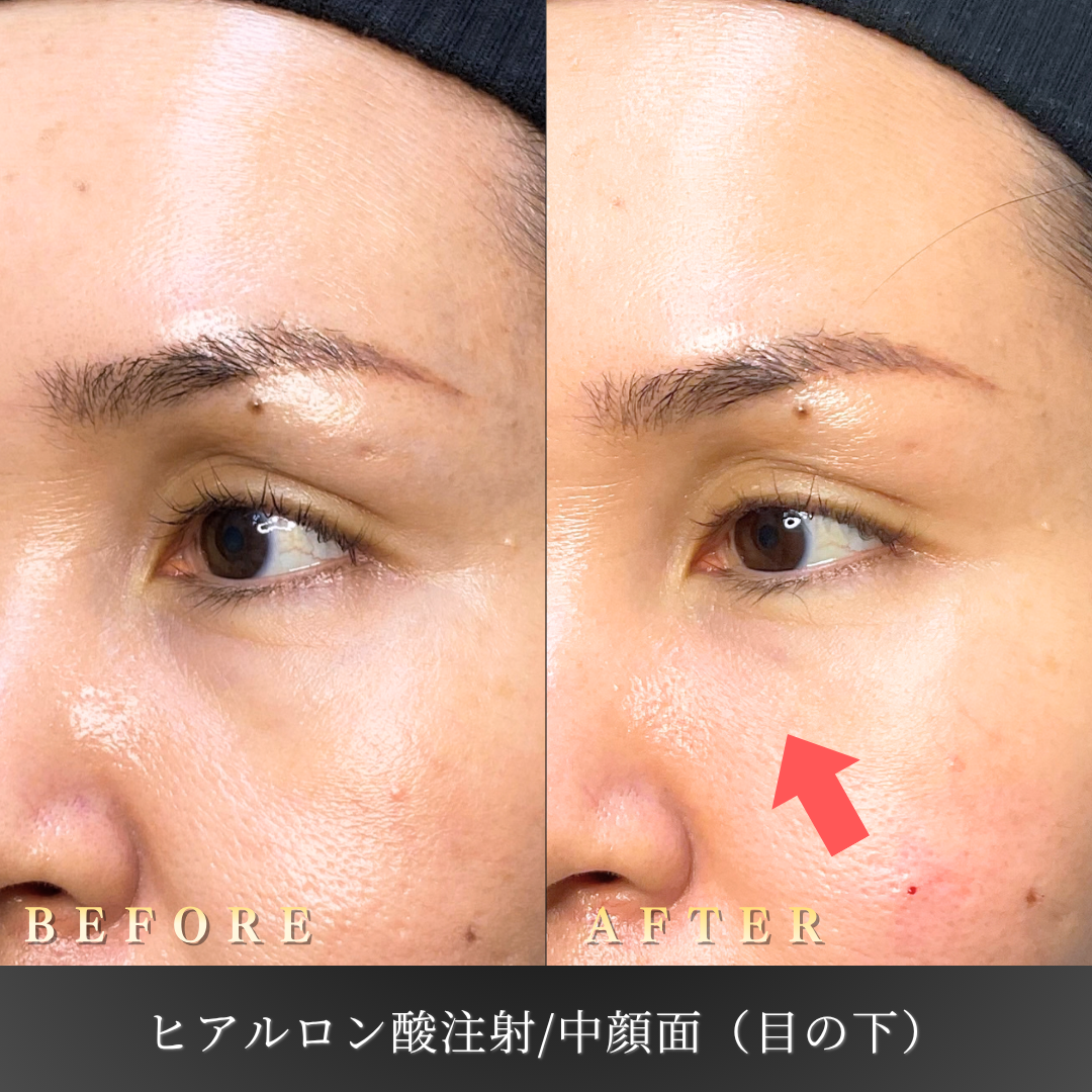 40代女性・中顔面（目の下のくま）のヒアルロン酸症例写真 2