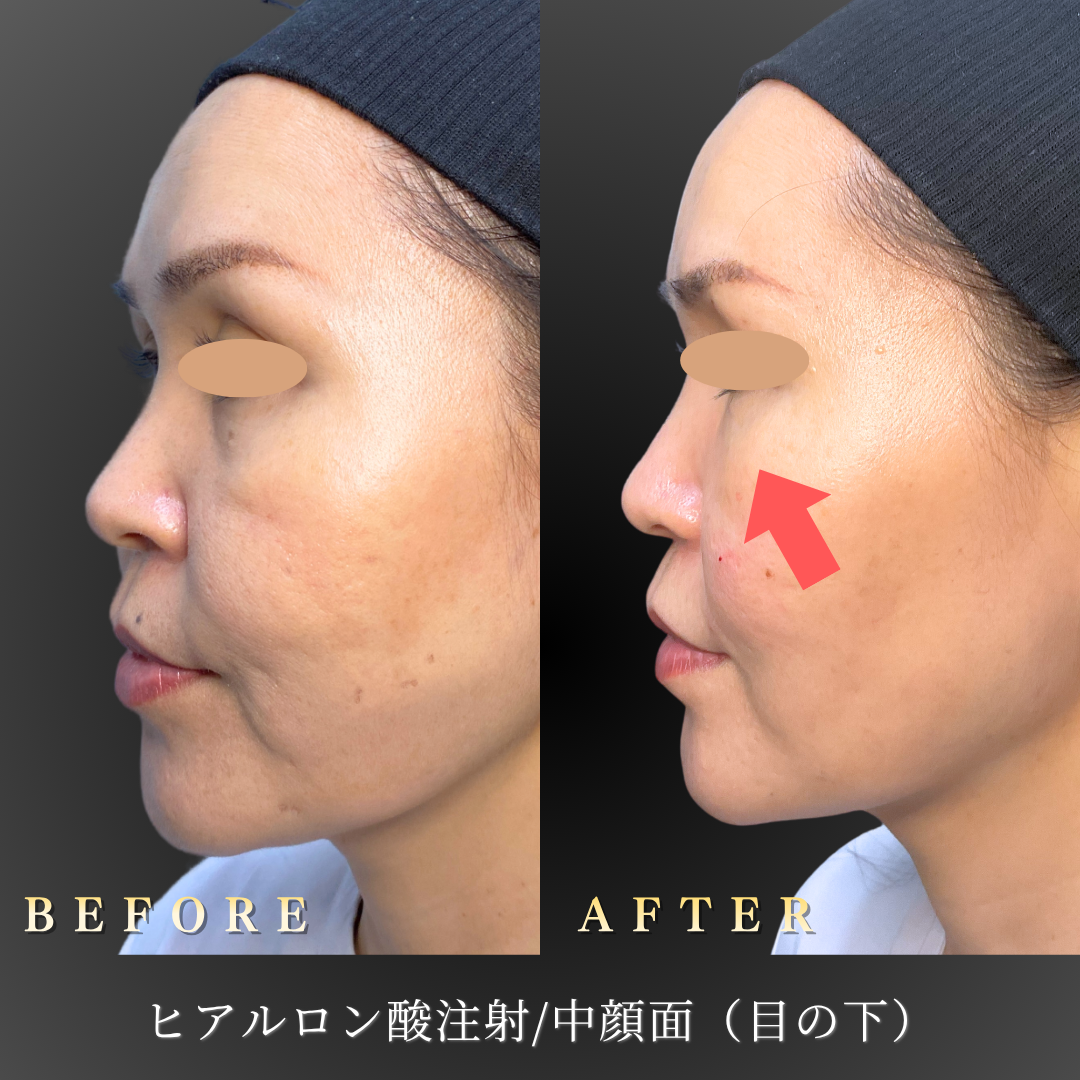 40代女性・中顔面（目の下のくま）のヒアルロン酸症例写真 3