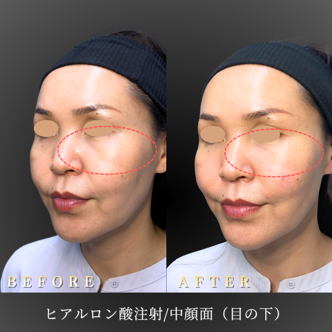 【40代女性】中顔面・目の下のヒアルロン酸注入症例｜大阪・心斎橋BiBiクリニックの症例写真