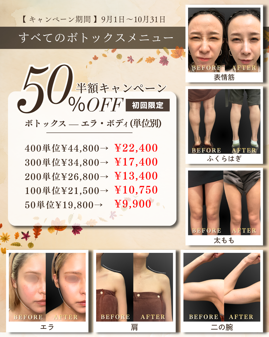 ボトックス半額キャンペーン