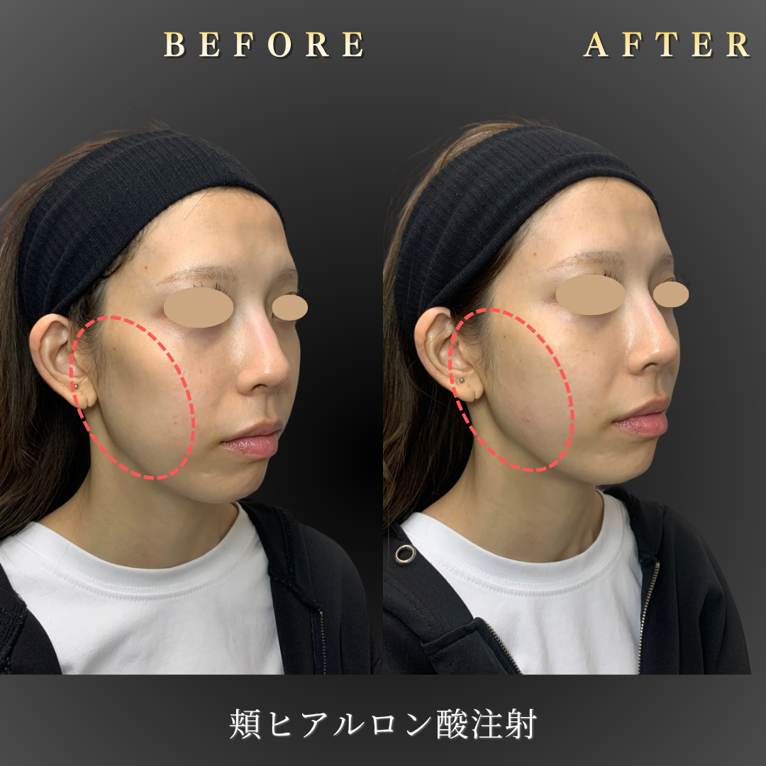 【20代女性】中顔面（頬こけ）のヒアルロン酸注入症例｜大阪・心斎橋BiBiクリニックの症例写真