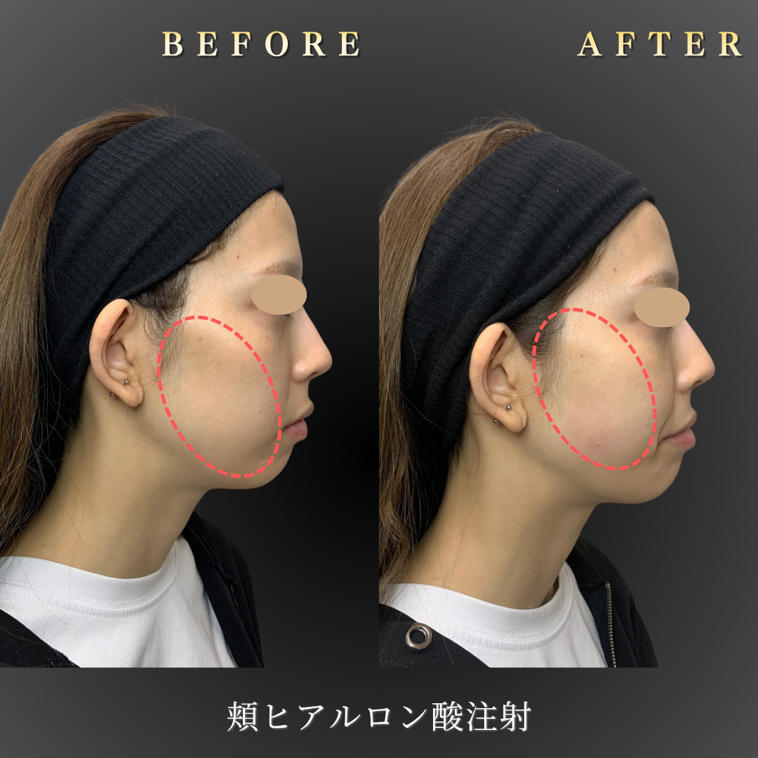 20代女性・中顔面（頬こけ）のヒアルロン酸症例写真 3